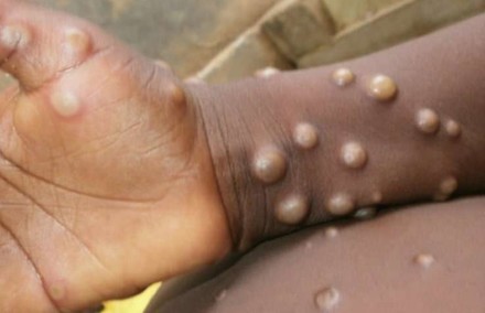 Niente allarmi in Italia per il vaiolo scimmie