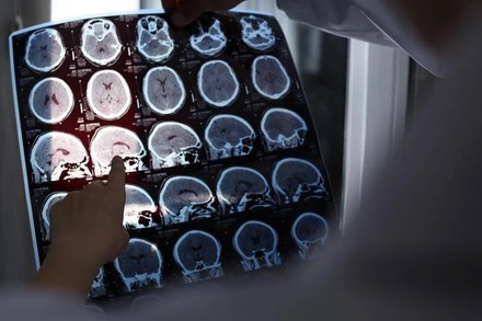 Medicina, si può rallentare l'Alzheimer con il litio